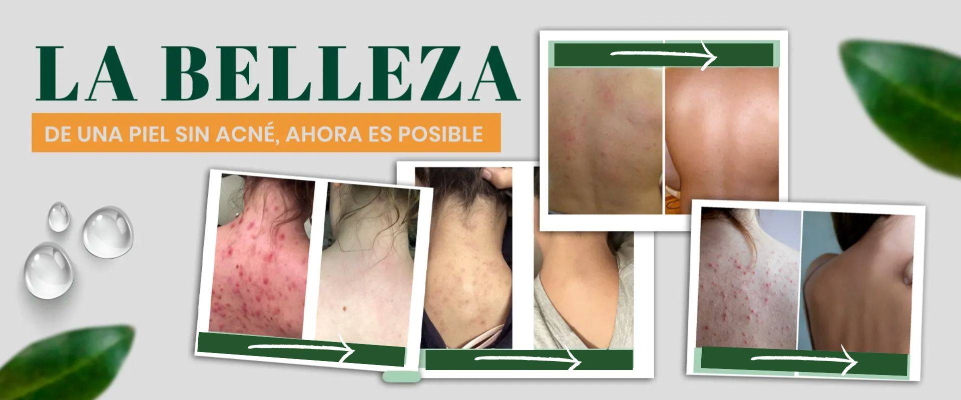 Aerosol para tratamiento en la espalda MEDix Beauty Secret